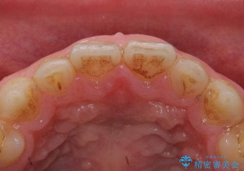 Kポップアイドルのような歯にしたい! 20代男性の治療前