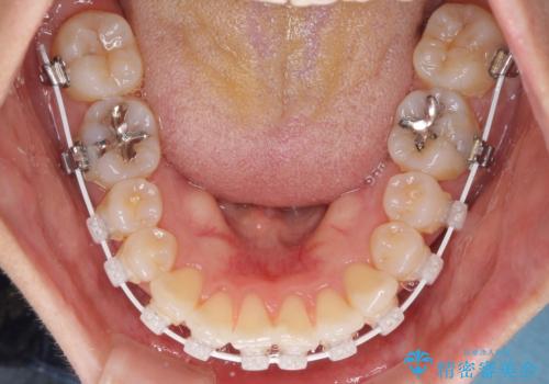 短期間で仕上げたい ワイヤーでの非抜歯矯正の治療中