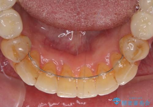 歯列不正と歯周病 総合歯科治療による全顎治療の治療後