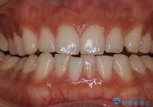 初めてのオフィスホワイトニング スペシャルコースの治療前
