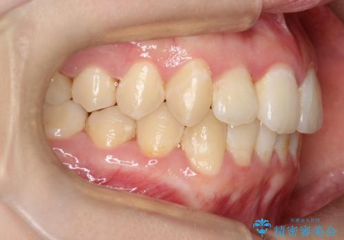 前歯が前後反対にかんでいる インビザラインによる矯正の治療後