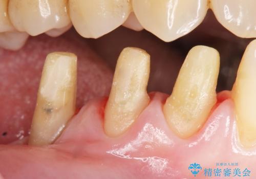 歯の動揺が気になる 低予算ではやく治したい 50代女性の治療中