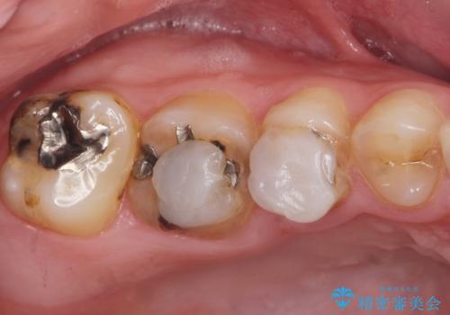 Kポップアイドルのような歯にしたい! 20代男性の治療前