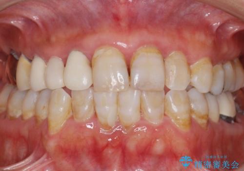 被せ物がかけた 綺麗で丈夫なセラミックのブリッジへ 60代女性の治療前