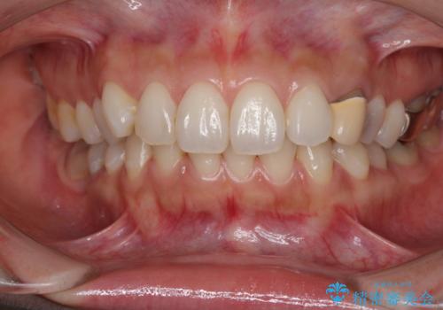 保険診療の変色したクラウン 前歯の審美歯科治療の治療前