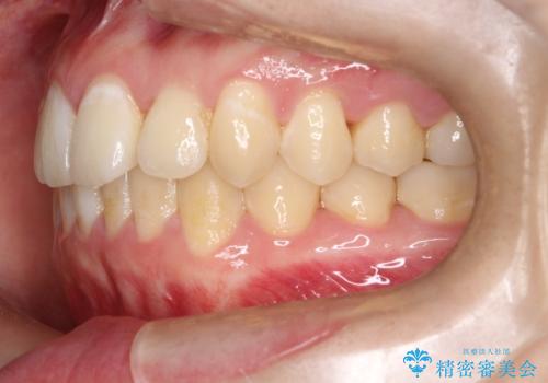 前歯が前後反対にかんでいる　インビザラインによる矯正の治療後