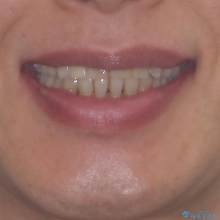 歯列不正と歯周病　総合歯科治療による全顎治療の治療後（顔貌）