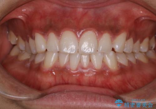 初めてのオフィスホワイトニング スペシャルコースの治療後
