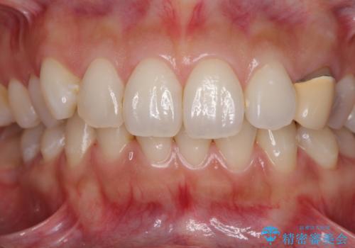 保険診療の変色したクラウン 前歯の審美歯科治療の治療前