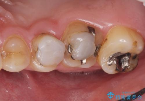 Kポップアイドルのような歯にしたい! 20代男性の治療前