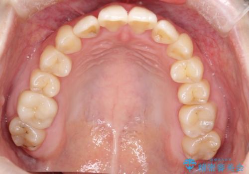 前歯が前後反対にかんでいる　インビザラインによる矯正の治療後