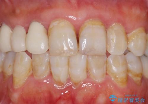 被せ物がかけた 綺麗で丈夫なセラミックのブリッジへ 60代女性の治療前