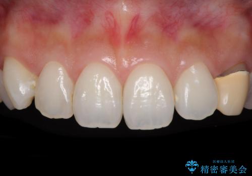 保険診療の変色したクラウン 前歯の審美歯科治療の症例 治療前