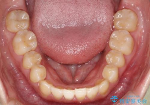 前歯が前後反対にかんでいる インビザラインによる矯正の治療後