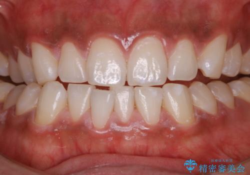 初めてのオフィスホワイトニング スペシャルコースの治療後