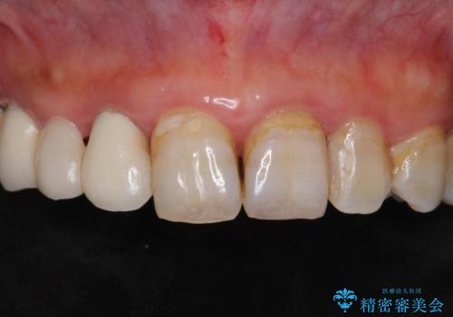 被せ物がかけた 綺麗で丈夫なセラミックのブリッジへ 60代女性の治療前