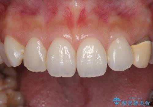 保険診療の変色したクラウン 前歯の審美歯科治療の治療前