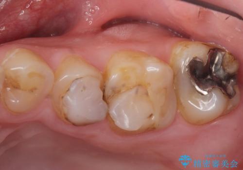 Kポップアイドルのような歯にしたい! 20代男性の治療前