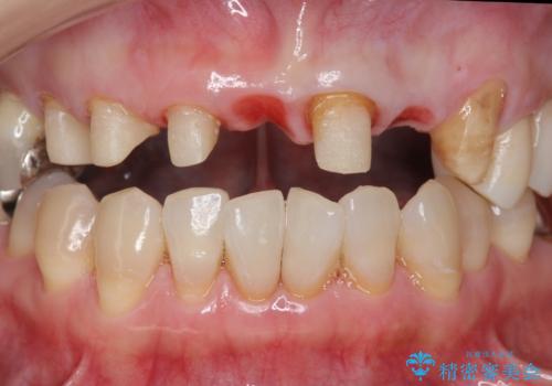 前歯のブリッジの下が虫歯　ブリッジのやりかえの治療中