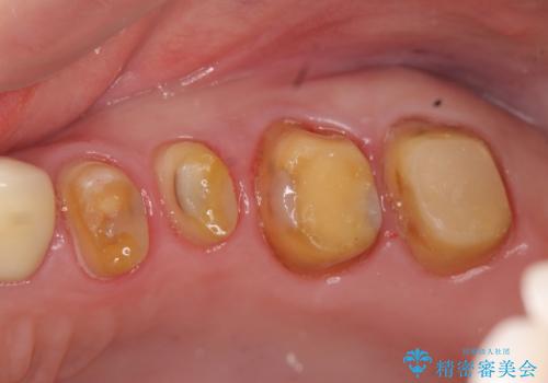 奥歯の被せ物のやり直し 精密根管治療の治療中