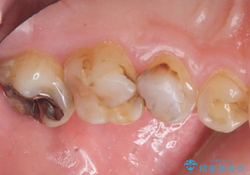 Kポップアイドルのような歯にしたい! 20代男性の治療前