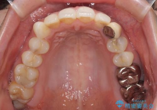 保険診療の変色したクラウン 前歯の審美歯科治療の治療前