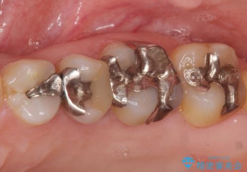 歯ぐきを押すと痛い 神経が死んでいる歯の治療 40代女性の治療前