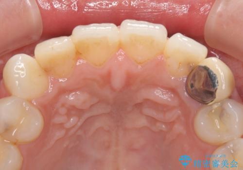 保険診療の変色したクラウン 前歯の審美歯科治療の治療前