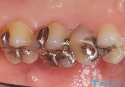 歯ぐきを押すと痛い　神経が死んでいる歯の治療　40代女性の治療前