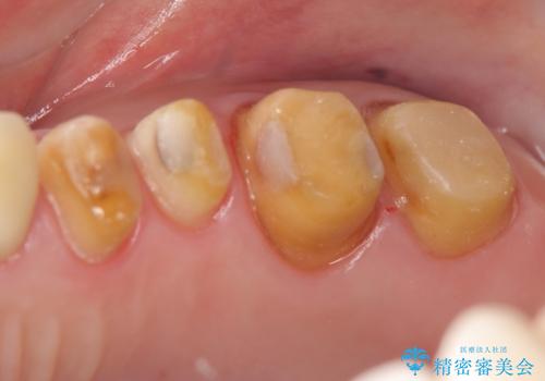 奥歯の被せ物のやり直し　精密根管治療の治療中