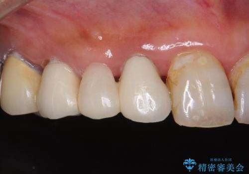 被せ物がかけた 綺麗で丈夫なセラミックのブリッジへ 60代女性の症例 治療前