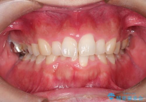全体のガタガタをインビザラインできれいな歯並びへの症例 治療前