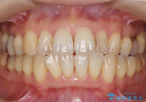歯が欠けた セラミッククラウンで綺麗に 40代女性の治療前