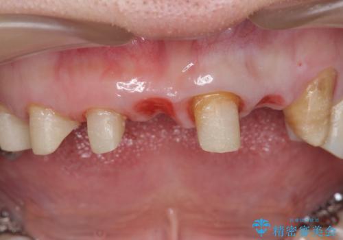前歯のブリッジの下が虫歯 ブリッジのやりかえの治療中