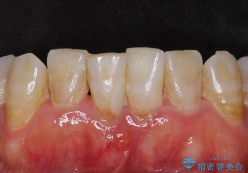 被せ物がかけた 綺麗で丈夫なセラミックのブリッジへ 60代女性の治療前
