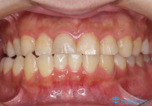 憧れの芸能人のような白い歯に 30代男性の治療前