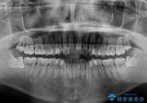 狭い歯列と前歯のデコボコ インビザラインによる矯正治療の治療前