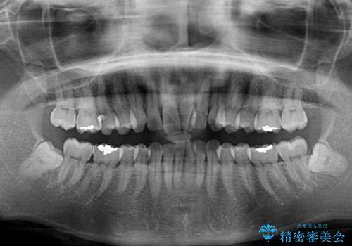 短期間で仕上げたい ワイヤーでの非抜歯矯正の治療前
