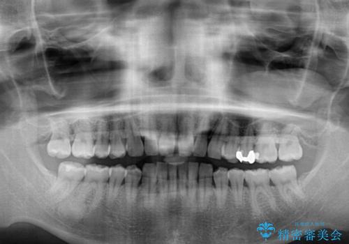 上顎の出っ歯とすきっ歯 補助装置を用いたインビザライン矯正の治療前