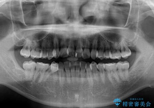 歯列全体のクロスバイトを治したい ワイヤー装置による矯正治療の治療前