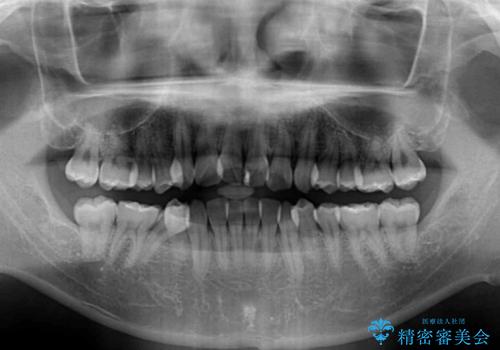 歯列全体のクロスバイトを治したい　ワイヤー装置による矯正治療の治療前