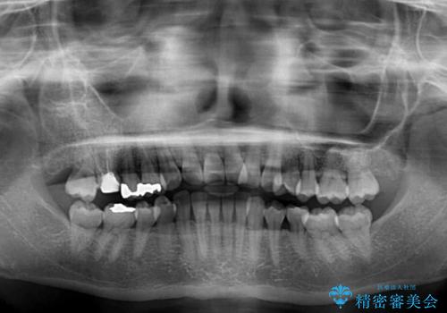 前歯のクロスバイト インビザライン矯正で改善の治療前