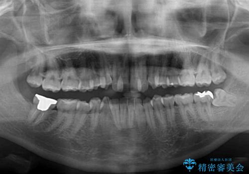 骨格的に左右にずれいている 前歯のデコボコをインビザラインで解消の治療前