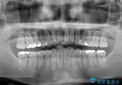冷たいものがしみて奥歯が痛い 気になる歯並びも治したの治療前