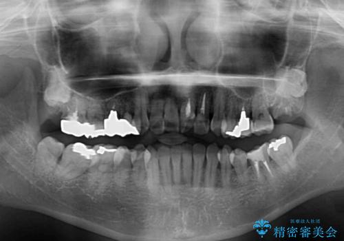 反対咬合で痛む前歯を改善 インビザラインによる矯正治療の治療前