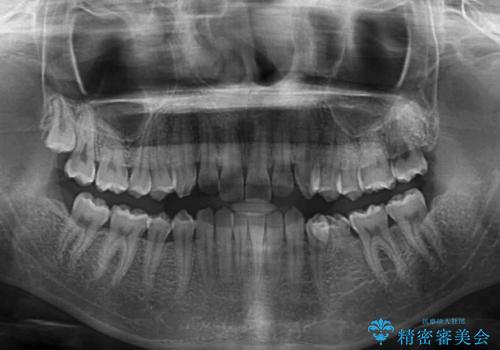 乳歯を抜いてインプラントに 咬み合わせ改善のインビザライン矯正の治療前