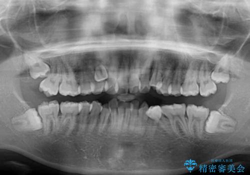 著しい叢生と顎骨のズレ ワイヤー装置による抜歯矯正の治療前