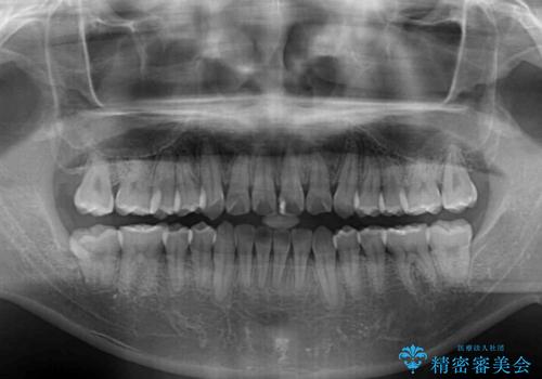 歯列全体のクロスバイトを治したい ワイヤー装置による矯正治療の治療後