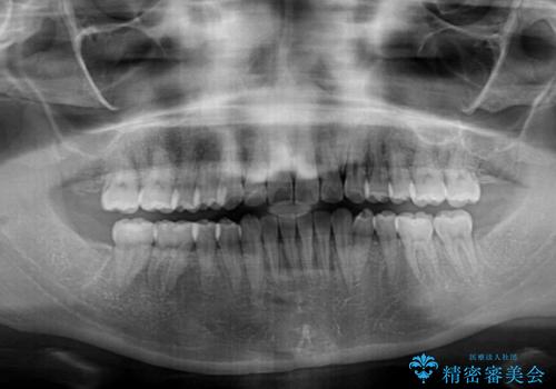 妊娠中に治療を終了　ワイヤー装置によるスピーディーな矯正治療の治療後