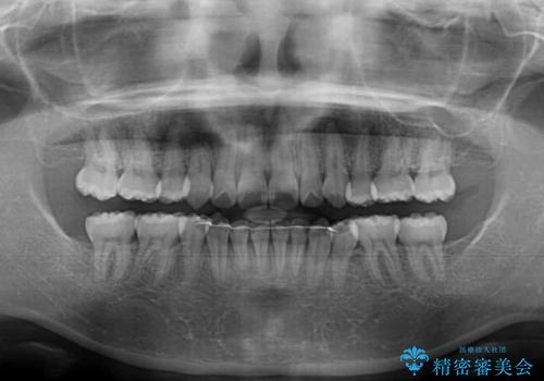 著しい叢生と顎骨のズレ　ワイヤー装置による抜歯矯正の治療後